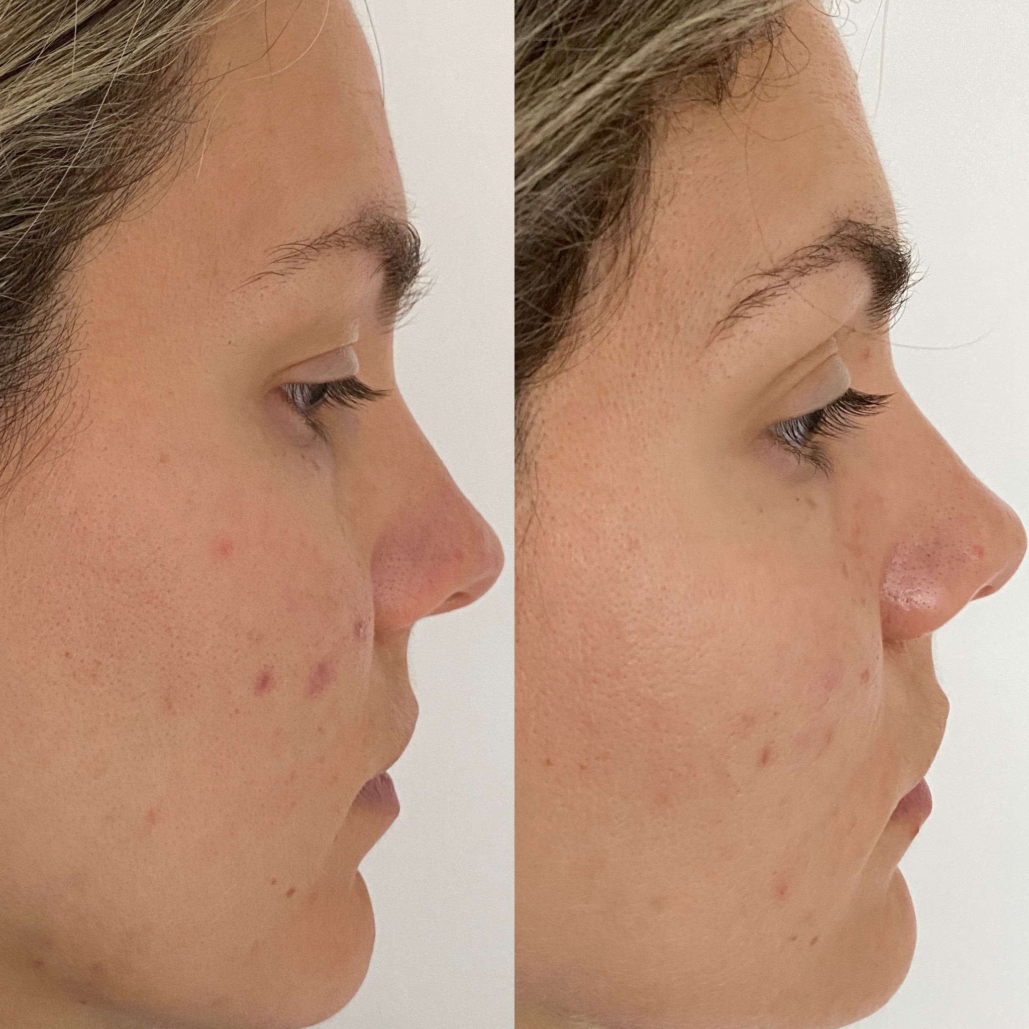 Dermalux Flex LED Skincare and Treatments Rachieroo